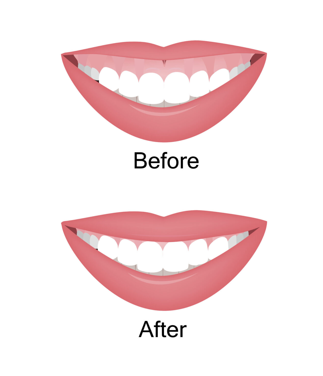 Get a Gorgeous Smile With Lip Repositioning Surgery - Your Health Magazine