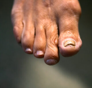 <strong>Is Toenail Fungus Contagious?</strong>