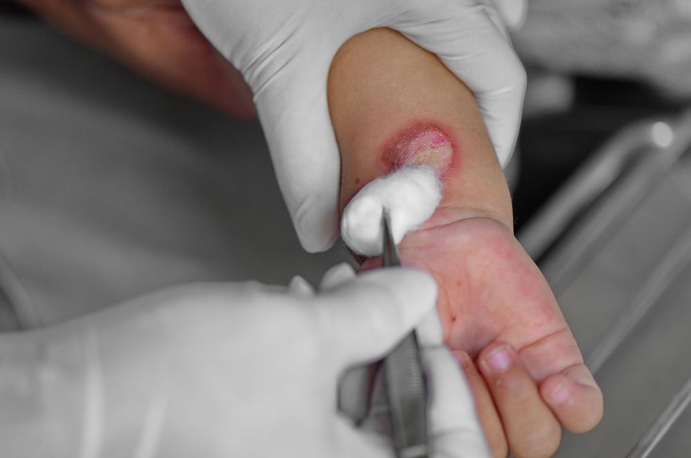 Should Burn Wounds Be Covered? - Your Health Magazine