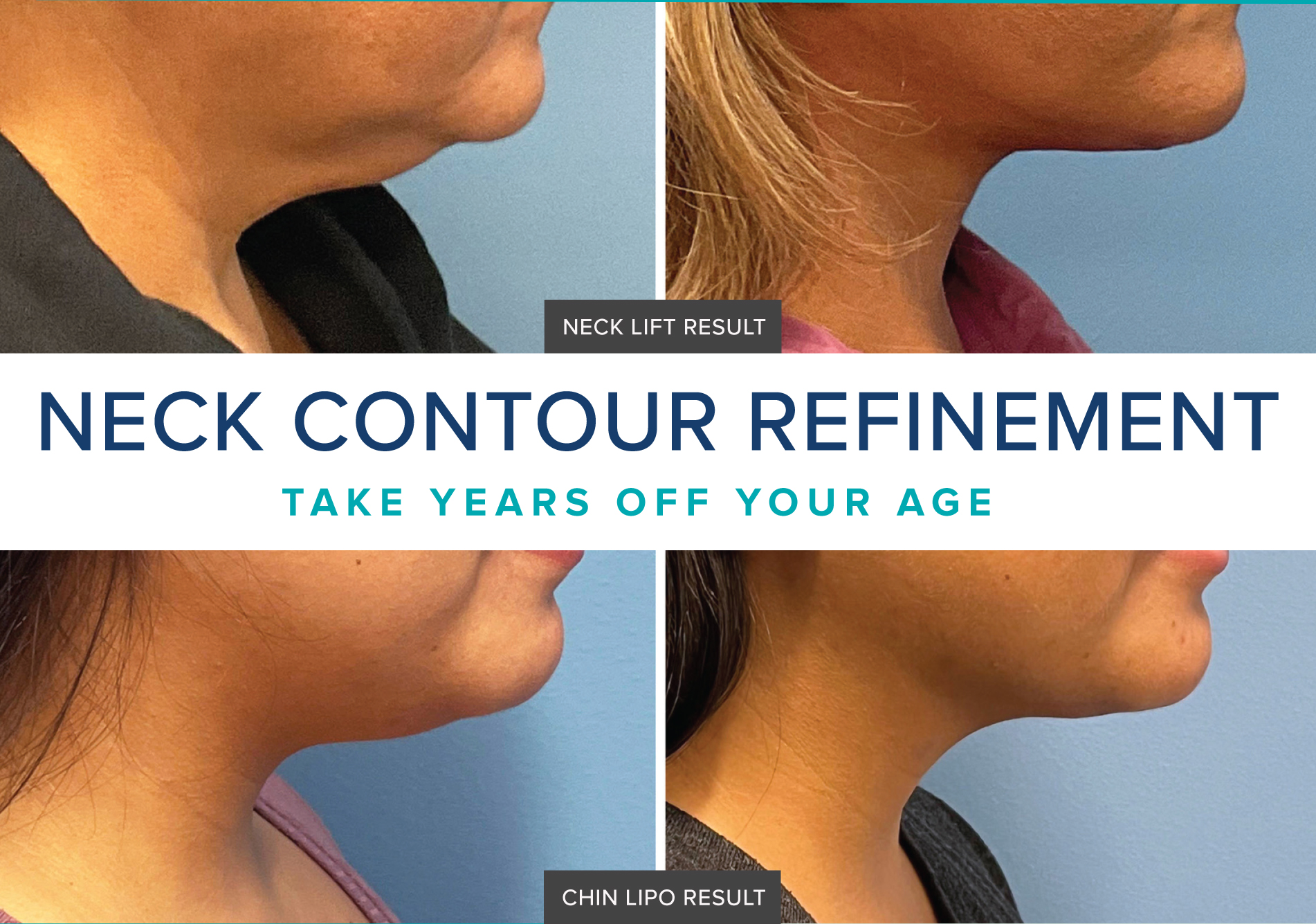 <strong>Five Options for an Improved Neck Contour</strong>