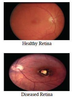 Retina Screening: <strong>Do You Need To Have One Done?</strong>