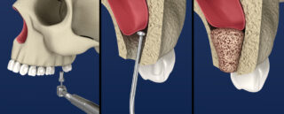 <strong>Crestal & Lateral Wall Sinus Lifting for Implants</strong>