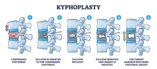 Kyphoplasty: A Breakthrough Treatment for Vertebral Compression Fractures