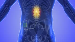 The Benefits of Spinal Cord Stimulation in Treating Chronic Pain