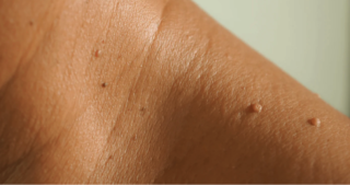<a></a>Comprehensive Guide to Understanding Skin Tags