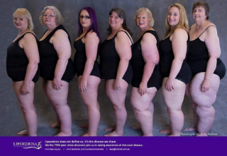 <strong>What Is Lipedema?</strong>