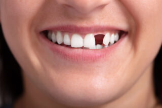Filling the Gap: Modern Options for Replacing Missing Teeth 