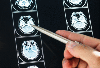 Common Challenges in Brain Injury Claims