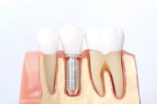 The Steps Involved in Getting and Restoring a Dental Implant