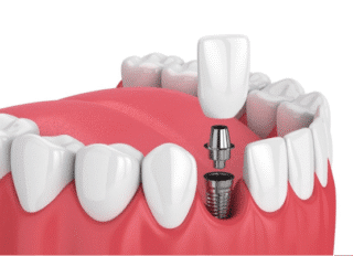 How to Prepare for Dental Implant Surgery