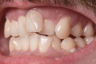 Crooked Teeth, Hidden Risks