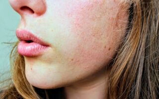 Effective Remedies for Combatting Dry Skin Next to Your Lip