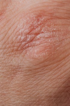 Managing the Challenges of Nummular Psoriasis for Healthier Skin