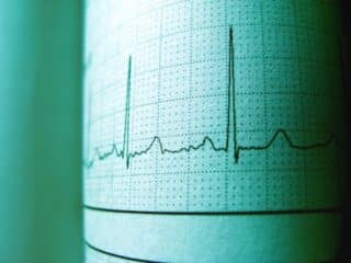 What Do Abnormal EKG Results Mean and What Causes Them?