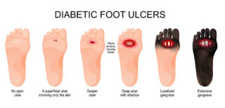 Diabetic Foot Care