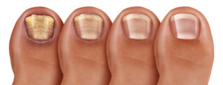 Signs Your Toenail Fungus Is Healing: How to Know If It’s Dying