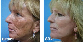 Understanding CO2 Skin Resurfacing