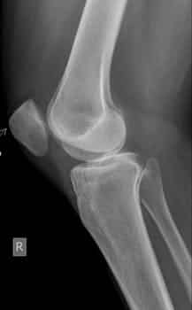 Patella Alta: Understanding Its Impact on Knee Health