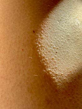 Effective Treatments for Molluscum Contagiosum: Is Freezing the Best Option?