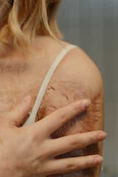 Managing Fixed Pigmented Erythema: Insights and Treatment Options