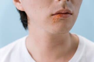 Herpes on Tongue: Symptoms, Causes, and Treatment Options