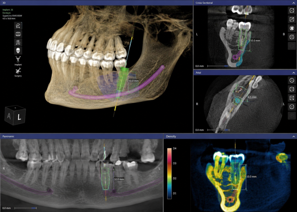 A 3D dental cone-beam scan showing jawbone density used to plan implant placement